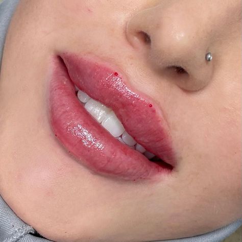 Dr. Ben Shatil on Instagram: “Dr. Ben’s Signature RUSSIAN LIPS 💉 Swipe ⬅️ for Before and after 💣 . . 💉: Outpatient procedure ⏰: Takes 20 minutes 🤕: Pain is mild;…” Lips Fillers Russian, Russian Keyhole Lips, Natural Russian Lips, Russian Lips Filler Aesthetic, Russian Filler Lips, Lips Before And After, Russian Lips Filler 1ml, Russian Doll Lips, Lip Filler Russian