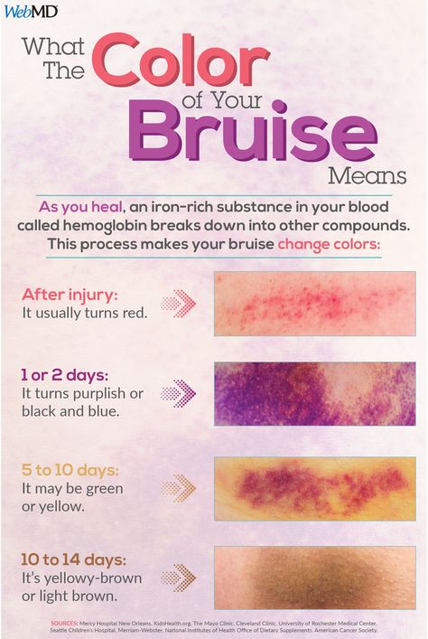 As a bruise heals, hemoglobin breaks down into other compounds. This process is what makes your bruise change colors. Materi Bahasa Jepang, Medical Student Study, Nursing School Survival, Nursing School Studying, Medical School Essentials, Nursing School Notes, Medical School Studying, Nursing School Tips, Medical Anatomy