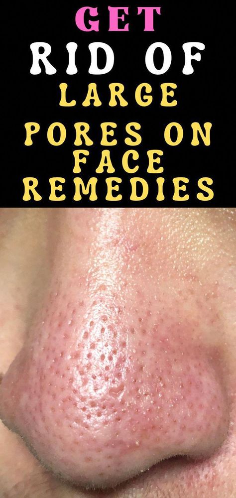 how to get rid of acne dark spots on face how to get rid of acne scars how to get rid of open pores how to get rid of open pores on face how to get rid of open pores naturally how to get rid of open pores on nose how to get rid of pores on face how to get rid of pores on nose how to remove pores how to remove pores on face how to remove pores on nose how to remove large pores on face get rid of large pores on face get rid of large pores on face remedies re #NaturalRemediesForArthritis Remove Pores On Face, Large Pores On Face, Large Pores On Nose, Pores On Nose, How To Remove Pores, Open Pores On Face, Pores On Face, Face Remedies, Get Rid Of Pores