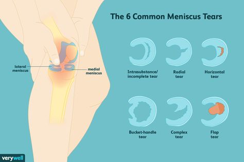 Meniscus Surgery Recovery, Meniscus Surgery, Knee Meniscus, Knee Surgery Recovery, Interesting Health Facts, Meniscal Tear, Knee Pain Relief Exercises, Knee Strengthening, Knee Ligaments