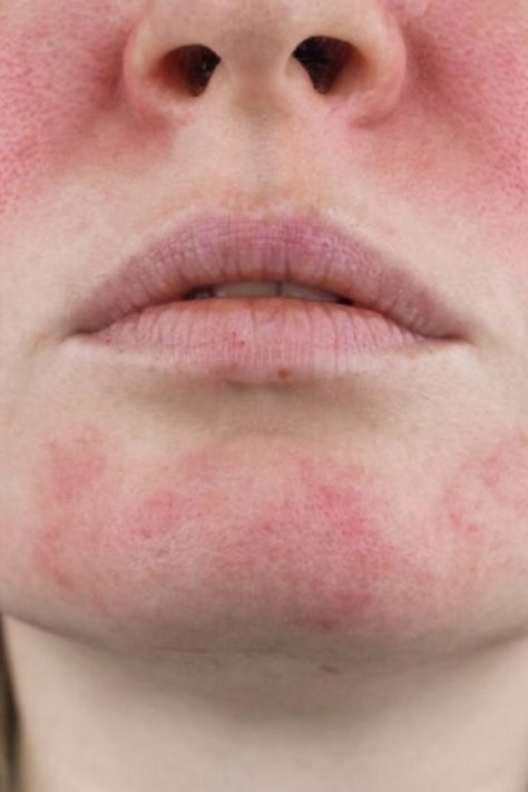 The National Rosacea Society (NRS) has introduced a new Seal of Acceptance program aimed at identifying skin care and cosmetic products that may be suitable for individuals suffering from rosacea. This chronic immune-mediated skin condition affects millions of people worldwide. It is characterized by symptoms such as inflamed bumps, redness, swelling, and visible blood vessels. Now, people who are suffering with flare-ups will have some guidance before adding to cart. Sustained Investigation, Inflamed Skin, Health Chart, A Seal, Red Skin, Skin Redness, Skin Condition, Cosmetic Products, Face Skin Care
