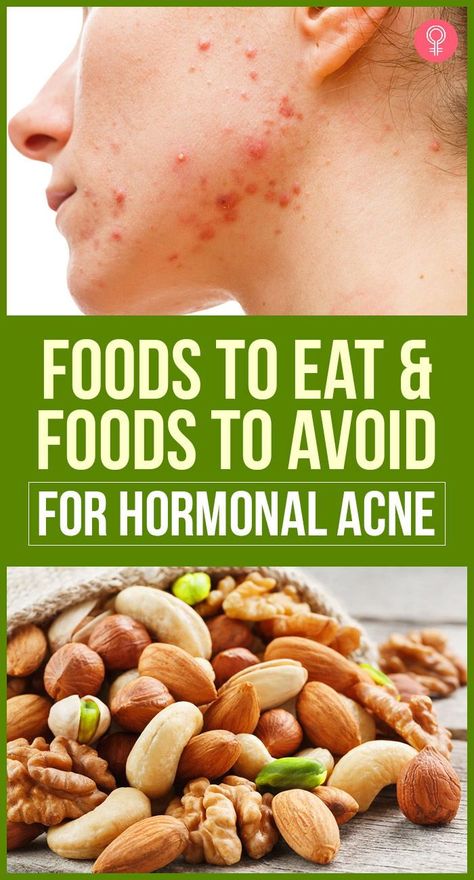 Foods To Eat And Foods To Avoid For Hormonal Acne: The changes could be something as simple as meditating for ten minutes daily to destress or something big like changing the fabrics you use or getting a good face wash. So in this article, we’re going to cover one such lifestyle change you can make- changing your diet. So here is a list of food items to eat and those to avoid. #hormonalacne #acne #beauty #beautytips Good Face Wash, Food For Acne, Back Acne Remedies, Acne Beauty, List Of Food, Clear Skin Diet, Acne Diet, Foods For Healthy Skin, Good Face