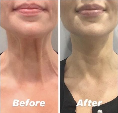 Neck Fillers Before And After, Botox In Neck, Wrinkles Before And After, Botox Neck Before After, Neck Botox Before And After, How To Remove Neck Lines, Neck Rejuvenation, Loose Neck Skin, Wrinkles Under Eyes