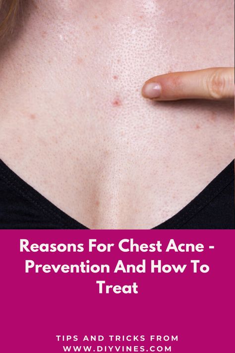 Reasons for chest acne are same as regular acne.  Chest acne is also called body acne. The main reason for Chest  acne is overproduction of sebum by the sebaceous glands. When there is an over production of sebum (skin oil) in body, skin pores become clogged.  #acne #chestacne #acnecauses #acneprevention #acnetreatment #beautytips #DIY #homeremedies Chest Acne Remedies, Body Acne Remedies, Acne Reasons, Pregnancy Acne, Chest Acne, Prevent Pimples, Pimples Under The Skin, Bad Acne, Body Acne