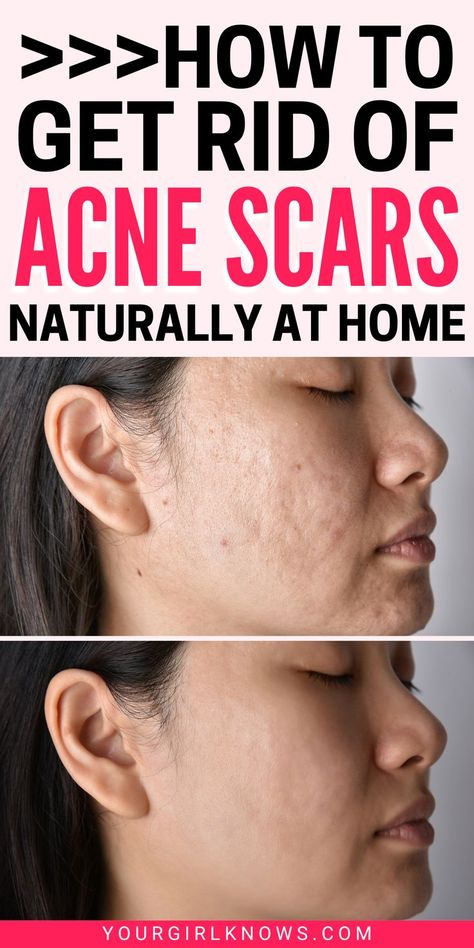 Are you struggling with acne scars? Don't worry, we have the solution. These tips will help clear up your skin and get rid of those pesky scars for good. So what are you waiting for? Start following these steps today! How To Remove Acne Scar Marks, Diy Acne Scar Remover, How To Get Rid Of Scars From Acne, Face Mask For Acne Marks, How To Remove Acne Marks, How To Get Rid Of Acne Marks, Scar Removal Diy, Get Rid Of Acne Marks, Acne Pit Scars