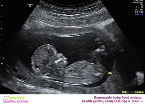 Ultrasound At 12 Weeks – All You Need To Know 3 Month Ultrasound, Boy Ultrasound Pictures, 3rd Month Pregnancy, Boy Ultrasound, 12 Week Ultrasound, 17 Weeks Pregnant, Third Month Of Pregnancy, 15 Weeks Pregnant, 12 Weeks Pregnant