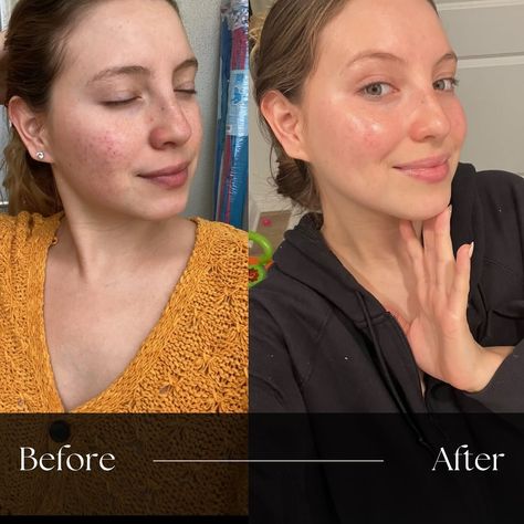 Love this testimony and how it has helped her skin so much 🥹♥️ even the confidence in her face on the second picture! 🥹👏🏼 So how does Amor help with blemishes and acne scars? Here’s why! 🌺 Hibiscus is rich in antioxidants which help combat free radical damage caused by environmental stressors like pollution and UV radiation. This can help to reduce premature aging and reduce the appearance of wrinkles and fine lines. Hibiscus also has exfoliating properties that help to lighten dark spot... Hibiscus, Lighten Dark Spots, Free Radicals, Dark Spots, Pollution, Wrinkles, Two By Two, Acne, Confidence