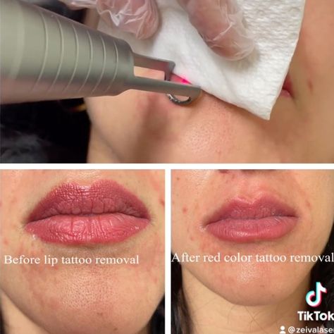 Lip Liner Tattoo Gone Wrong - Why It Happens & What to Do Lip Liner Tattoo, Tattoos Gone Wrong, Liner Tattoo, Lip Blushing, Laser Removal, Lip Tattoo, Lip Enhancement, Semi Permanent Makeup, Cosmetic Tattoo