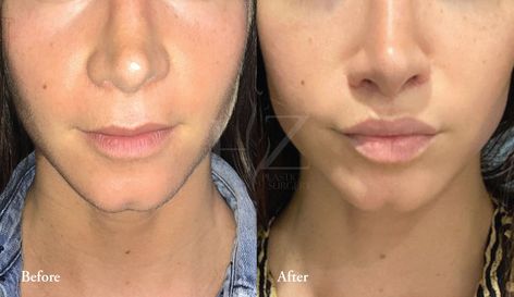 upper lip lift orlando, what is an upper lip lift, upper lip lift surgery, hz plastic surgery Corner Lip Lift, Lower Face Lift Before And After, Lip Lift Before And After, Eyebrow Lift Surgery, Lip Plastic Surgery, Lip Lift Surgery, Round Lips, Upper Lip Lift, Upper Lip Wrinkles