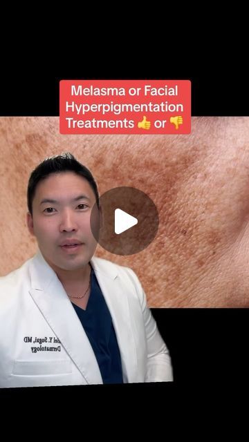 Dr. Daniel Sugai, MD, FAAD on Instagram: "Hyperpigmentation, specifically melisma is a hot topic in my practice!

Here’s a few explanations: 
Niacinamide serums can cause irritant contact dermatitis rashes and may worsen #darkspotsonface and be careful when getting lasers as some lasers may worsen #melasma quite dramatically. 

I see contact dermatitis in those using hydroquinone purchased OTC overseas too. Always consult your doctor on how to use hydroquinone appropriately since it is a prescription medication that can paradoxically worsen hyperpigmentation if used incorrectly! 😱😩

#melasma #hyperpigmentation #hyperpigmentationtreatment #melasmatreatement nt" Hydroquinone 4% Before And After, Skin Discoloration Remedies, Hyperpigmentation Mask, Removing Hyperpigmentation, Skin Care Hyperpigmentation, Age Spots On Face, Dark Spots On Face, Spots On Face, Skin Discoloration