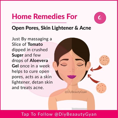 How To Remove Open Pores On Face, How To Reduce Pores On Face, Open Pores Remedy Natural Treatments, Skincare Pores, Open Pores On Face, Pores On Face, Acne Remedy, Home Remedies For Pimples, Face Mask For Pores