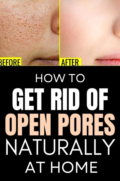 Minimize Pores Naturally, Open Pores On Face, Pores On Face, Get Rid Of Pores, Big Pores, Oily Skin Remedy, Nose Pores, Face Pores, Open Pores