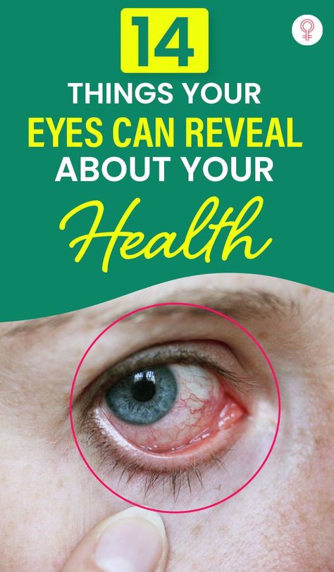 Eye Facts, Eye Twitching, Eye Exercises, Cold Sores Remedies, Sore Eyes, Natural Sleep Remedies, Healthy Eyes, Eyes Problems, Natural Cold Remedies