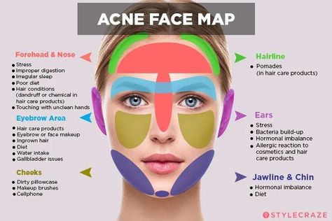 Acne Face Map, Acne Mapping, Cheek Acne, Face Map, Acne Reasons, Face Mapping Acne, Prevent Pimples, Forehead Acne, Acne Face