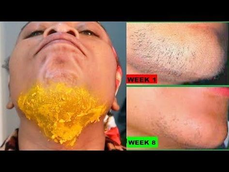 #HowToPermanentlyRemoveHair #EasyWayToRemoveUnwantedBodyHair Remove Facial Hair Permanently, Natural Facial Hair Removal, Diy Facial Hair Removal, Natural Hair Removal Remedies, Chin Hair Removal, Remove Facial Hair, Hair Remove, Remove Body Hair Permanently, Face Hair Removal