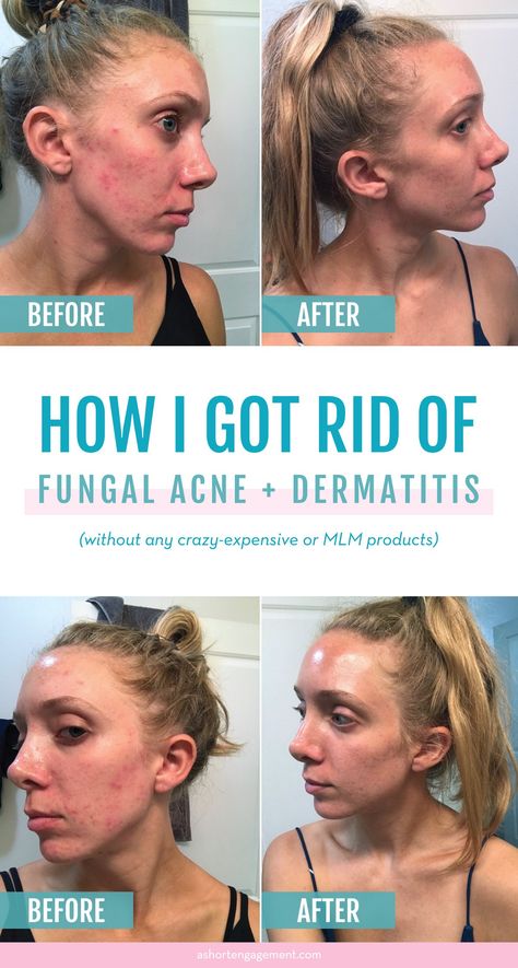 Acne, Fungal Acne or Dermatitis? How I Cured the Worst Skin of my Life – A Short Engagement Fungal Acne, Trigun Stampede, Bad Acne, Short Engagement, Natural Acne, Moisturizer For Oily Skin, Hormonal Acne, Cystic Acne, Acne Remedies