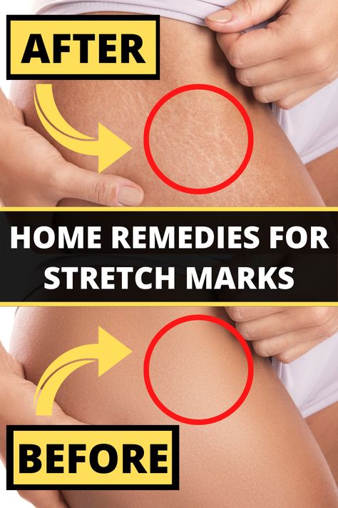 Stretch marks are those fine lines that are very common on the body parts. Today we look at home remedies to deal with it. #stretchmarks #homeremedies Discover Your Perfect Stretch Mark Cream! 💞 stretch mark and scar cream, stretch mark fade cream, stretch marks remedy #wellness #healthyskin #naturalremedies Stretch Mark Remedies, Scar Cream, Stretch Mark Removal, Stretch Mark Cream, Natural Healing Remedies, Stretch Mark, Skin Essentials, Vicks Vaporub, Deal With It