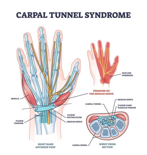 Pregnancy and Carpal Tunnel Syndrome - Giggle Magazine Carpal Tunnel Anatomy, Carpel Tunnel Syndrome, Physical Therapy Student, Median Nerve, Computer Vector, Muscular System, Hand Pain, Muscle Anatomy, Nerve Damage