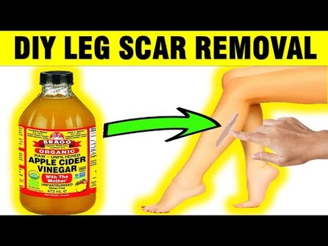 How To Remove Scars On Legs Fast, Leg Scars, Get Rid Of Sunburn, Dark Spots On Legs, Hair Stages, Spots On Legs, Lighten Dark Spots, Beautiful Gray Hair, Gray Hair Growing Out