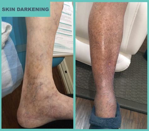 Skin Darkening Skin Discoloration On Legs Signs, Leg Discoloration, Leg Rash, Dark Spots On Legs, Skin Darkening, Spots On Legs, Swollen Ankles, Venous Insufficiency, Flaking Skin