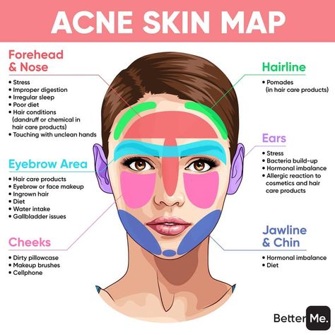 Pro.Skin Laser & Aesthetics on Instagram: “THIS IS WHAT ACNE SAYS ABOUT YOUR HEALTH👆🏻👁 Where do you usually have acne and do you agree with our map?👇🏻 Repost from @betterme.weightloss” London Aesthetics, Acne Mapping, Cheek Acne, Skin Mapping, Hair Diet, Aesthetic Treatments, Acne Reasons, Back Acne Remedies, Forehead Acne