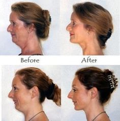 Tone double chin and get a defined jawline with face aerobics workouts. Use toning exercises to lose turkey neck and double chin without needing surgery procedures Saggy Cheeks, Defined Jawline, Face Lift Exercises, Beachbody Workout, Double Chin Removal, Double Chin Exercises, Toning Exercises, Chin Exercises, Double Menton