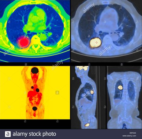 Positron emission tomography (PET) scans of a patient with a tumour the upper lobe of the left lung. Stock Photo Technology, Positron Emission Tomography, Pet Scan, Upper Lobe, Starry Night, Stock Photo, Stock Images, Resolution, Stock Photos