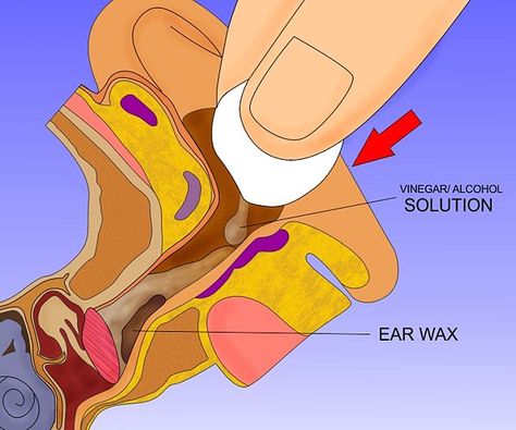 Get Rid of Ear Wax - wikiHow Clean Ear Wax Out, Swimmers Ear Remedy, Impacted Ear Wax, Ear Cleaning Wax, Ear Wax Candle, Clogged Ears, Remedy For Sinus Congestion, Swimmers Ear, Ear Wax Buildup