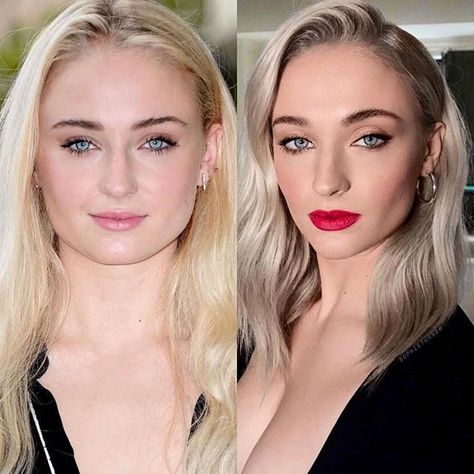 Winter is here and looking better than ever ❄️👑 Sophie Turner from Game of Thrones looking amazing after what appears to be cheek, chin and… Botox Jaw, Square Jawline, Face Plastic Surgery, Chin Reduction, Good Jawline, Face Surgery, Face Fillers, Botox Before And After, Cheek Fillers