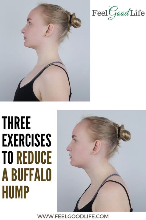 Buffalo Neck Exercise, Improve Posture Exercises, Hunch Back, Hunched Back, Buffalo Hump, Shoulder Pain Exercises, Neck Hump, Primal Movement, Chin Tuck