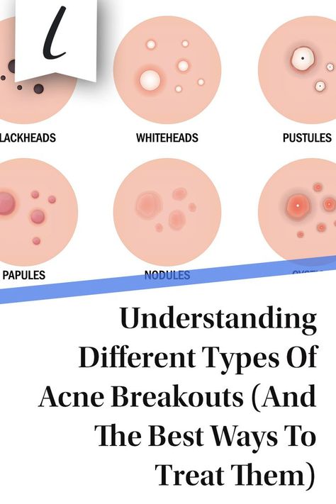 Breakout Map, How To Treat Pimples, Home Remedies For Face, Different Types Of Acne, Remedies For Acne, Face Mapping Acne, Acne Prone Skin Care, Skin Bumps, Acne Skincare Routine