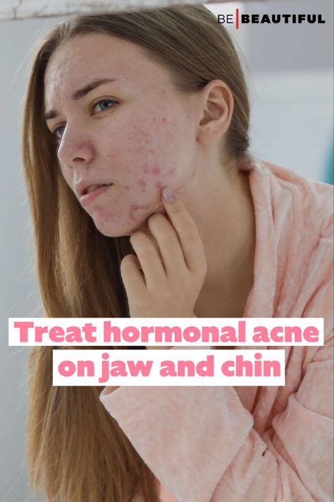 Treating hormonal acne Chin Acne Causes, Treat Hormonal Acne, Jawline Acne, Painful Acne, Chin Acne, Hormonal Imbalance, Acne Causes, Hormonal Acne, Acne Breakout