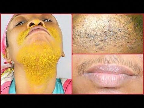 #khichibeauty #khichibeautyskincare #ALESMAXiiHOW TO GET RID OF UPPER LIPS CHIN AND SIDE HAIR ON THE FACE, HOMEMADE HAIR REMOVERThe most common spots where y... Stop Facial Hair Growth, Homemade Hair Removal, Diy Facial Hair Removal, Natural Hair Removal Remedies, Upper Lips, Female Facial Hair, Chin Hair Removal, Lip Hair Removal, Remove Body Hair Permanently