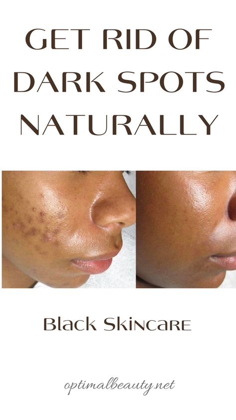 Black Skin Care Dark Spots, Black Spots On Face, Dark Spot Remover For Face, Oily Skin Remedy, Acne Dark Spots, Dark Spots On Face, Natural Face Skin Care, Black Skin Care, Spots On Face