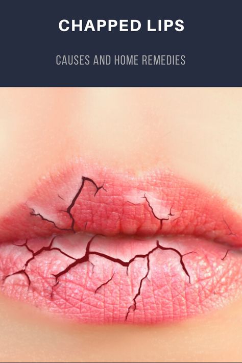 How To Heal Dry Cracked Lips, Chapped Lips Aesthetic, Dry Lips Causes, Lips Cracked, Cold Sore Lip, Dry Lips Remedy, Aloe Vera For Sunburn, Dry Lip, Sunburn Peeling
