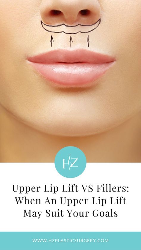 plastic surgery, upper lip lift, upper lip lift vs fillers Lip Plastic Surgery, Lip Lift Surgery, Upper Lip Lift, Frank Tattoo, Lip Surgery, Lip Lift, Upper Lip Hair, Lip Enhancement, Tattoo Clothing