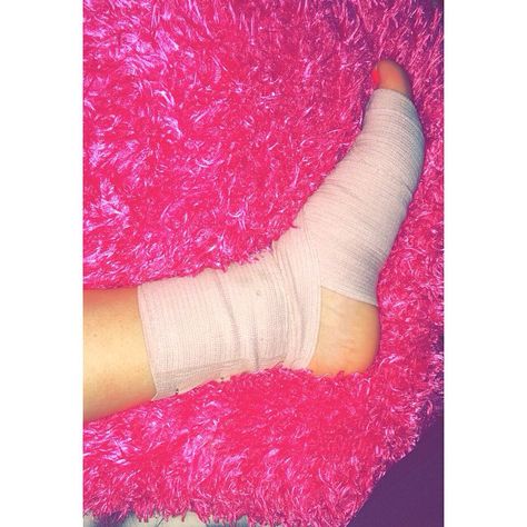 Sprained my foot... Not fun Leg Plaster Snapchat, Leg Fracture Snap, Leg Injury Snapchat Streaks, Broken Leg Snapchat Story, Leg Fracture Snapchat, Sprained Ankle Snapchat, Leg Injury Fake Story, Injured Leg Snapchat, Leg Bandage Snapchat