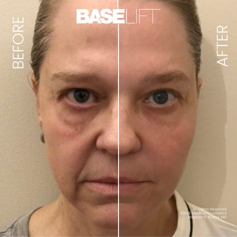 Losing support under the skin is a natural occurrence called atrophy. The lost support can be restores by using various cosmetic fillers during Dr. Stephen Bracci's non-surgical facelift procedure, the BaseLift™. The VERVE Baselift™ will ✨ Restore the natural shape of the face with artistically injected cosmetic fillers ✨ Sculpt the face back to its original form while maintaining a natural look ✨ Provide immediate results and minimal downtime—no threads, devices or surgery Eye Filler, Cosmetic Fillers, Facelift Procedure, Facial Aging, Non Surgical Facelift, Marionette Lines, Nyc Photos, Facial Wrinkles, The Verve