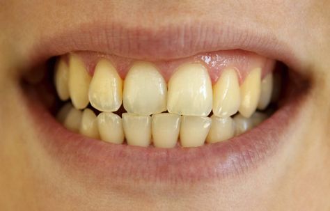 Natural Teeth Whitening, Whiten Teeth Fast, Teeth Whitening Remedies, Whiter Teeth, Yellow Teeth, Stained Teeth, Beauty Remedies, White Teeth, Oral Hygiene