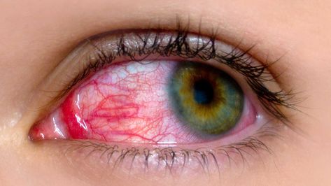 Symptoms of Glaucoma Natural Pink Eye Remedy, Pinkeye Remedies, Rare Eyes, Irritated Eye, Smile Images, Eye Infections, Sore Eyes, Eyes Problems, Dry Eyes