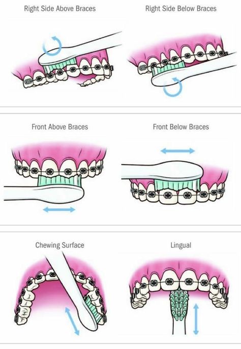 Dental Braces Colors, Pink Braces, Braces Teeth Colors, Kawat Gigi, Braces Color, Braces Teeth, Cute Braces Colors, Pretty Teeth, Braces Tips