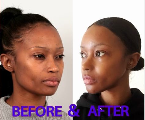 Click to read her story. She had Forehead reduction, Rhinoplasty, V-line surgery, Cheekbone reduction and Fat graft in ID Hospital.  #idhospital #cheekbonereduction #fatgraft #mommymakeover #vline #vlinesurgery #rhinoplasty #plasticsurgerinkorea #plasticsurgerybeforeafter #koreanplasticsurgery #antiaging #transformation #transformationpicture Reduction Rhinoplasty, Perfect Forehead, Cheekbone Reduction, Nostril Reduction, Forehead Reduction, V Line Surgery, Face Plastic Surgery, V Line Face, Korean Plastic Surgery