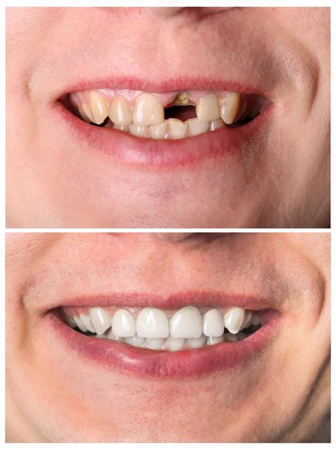 If you have a damaged or decayed tooth, your dentist may recommend chairside dental restoration. Our dental practice offers a variety of tooth restoration dental services, including crowns, bridges, and dental implants. Teeth Bonding, Dental Bonding, Dental Restoration, Dental Decay, Dental Exam, Dental Fillings, Restorative Dentistry, Teeth Implants, Dental Bridge