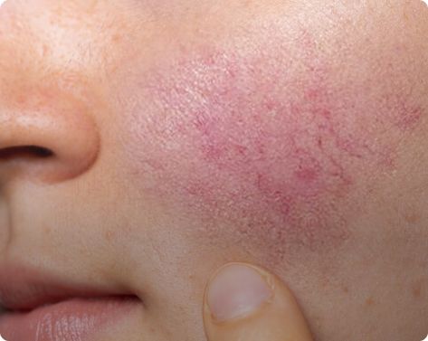 Pustules Acne, Blind Pimple, Natural Acne Remedies, Brown Spots Removal, Dark Under Eye, Body Hair Removal, Hair Solutions, Unwanted Hair Removal, Chronic Condition