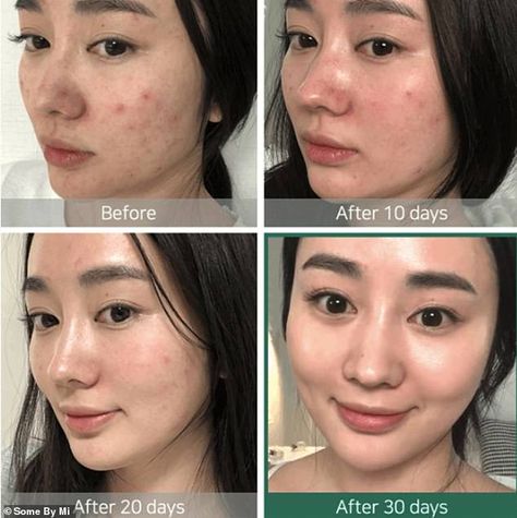 The Korean 'miracle' toner that has sold over 1.2 million units - and it gets rid of acne in 30 days | Daily Mail Online Glass Skin Before And After, Some By Mi Aha Bha Pha, Niacinamide Before And After, 30 Days Miracle Toner, Miracle Toner, Korean Toner, Some By Mi, Skin Care Routine For 20s, Skin Care Toner Products