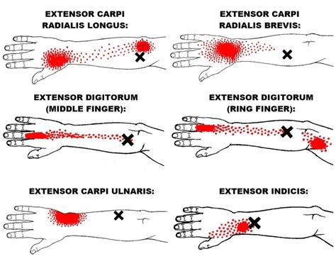 Punkty Spustowe, Shiatsu Massage Acupressure, Acupuncture Benefits, Esports Games, Trigger Point Therapy, Wrist Pain, Trigger Point, Muscle Anatomy, Foam Rolling