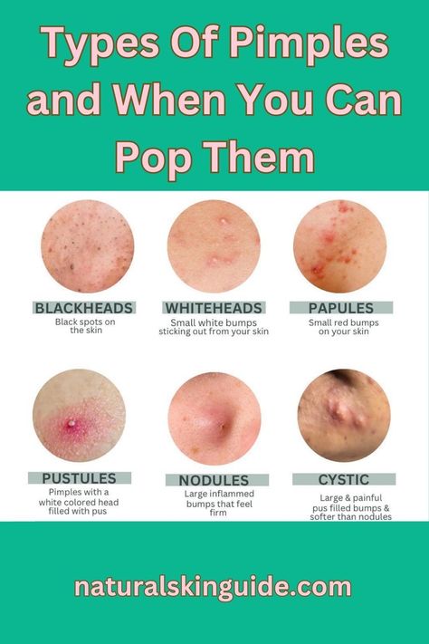 The BEST Guide On Pimple Poppin' Hard Pimple, Remedy For Sinus Congestion, Big Pimple, Cystic Pimple, Back Acne Remedies, Blind Pimple, Pimples Under The Skin, Pimples On Face, Acne Overnight