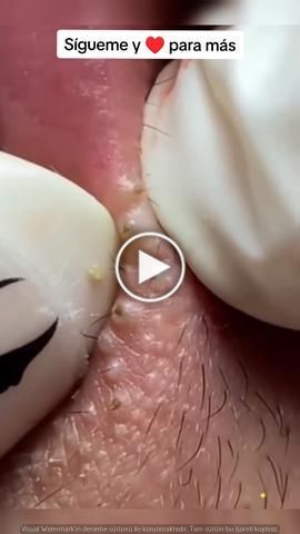 pimple popping / blackheads removal Big Blackheads Removal Satisfying Videos, Pimples Around Lips, Lip Blackheads, Pimples On Lip Line, White Pimples On Face, Cysts Popping Videos, Cystic Pimple Pop, Neck Pimples, Acne Popping