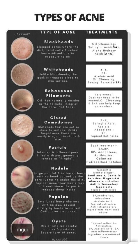 Combination Skincare Routine, Medical Skincare, Basic Skincare, Skin Facts, Skin Care Business, Skin Advice, Clear Healthy Skin, Serious Skin Care, Types Of Acne
