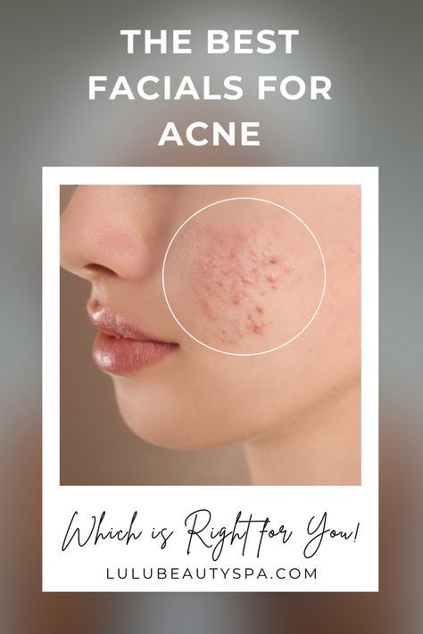 Facials For Acne, Anti Acne Skin Care, Best Facials, Natural Remedies For Acne, Remedies For Acne, Types Of Facials, Prevent Pimples, Acne Vulgaris, Facial Treatments